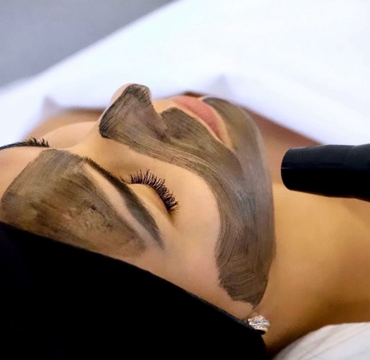 Laser Carbon Peel at Royal Clinic – Gentle Yet Powerful Skin Care